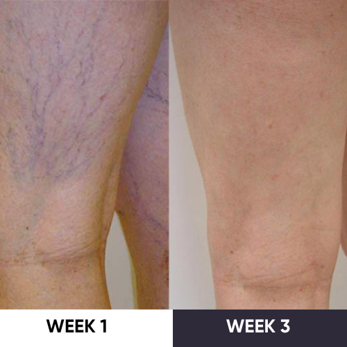 Synapik - VeinErase System