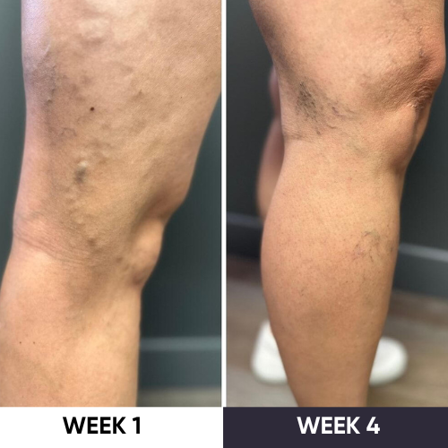Synapik - VeinErase System