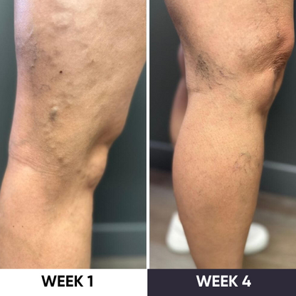 Synapik - VeinErase System