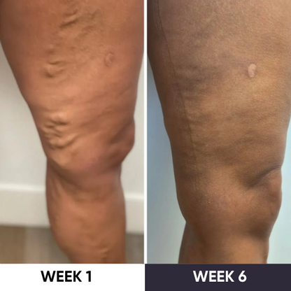 Synapik - VeinErase System