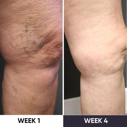 Synapik - VeinErase System